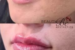 Lip fillers restore your smile and radiate confidence with fuller, plumper lips.